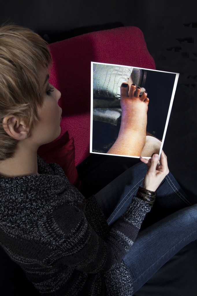 Heather Howe holds a photo of her mild Reflex Sympathetic Dystrophy/Complex Regional Pain Syndrome (RSD/CRPS), flare up. The odd position of the toes is referred to as dystonia, which can come from physical trauma. Photo: Lynn Levitt